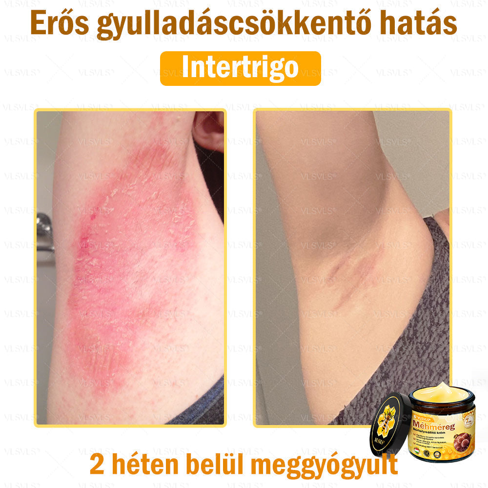 VLSVLS® Méhméreg Bőrhelyreállító Krém (👨⚕CE jóváhagyott)💎