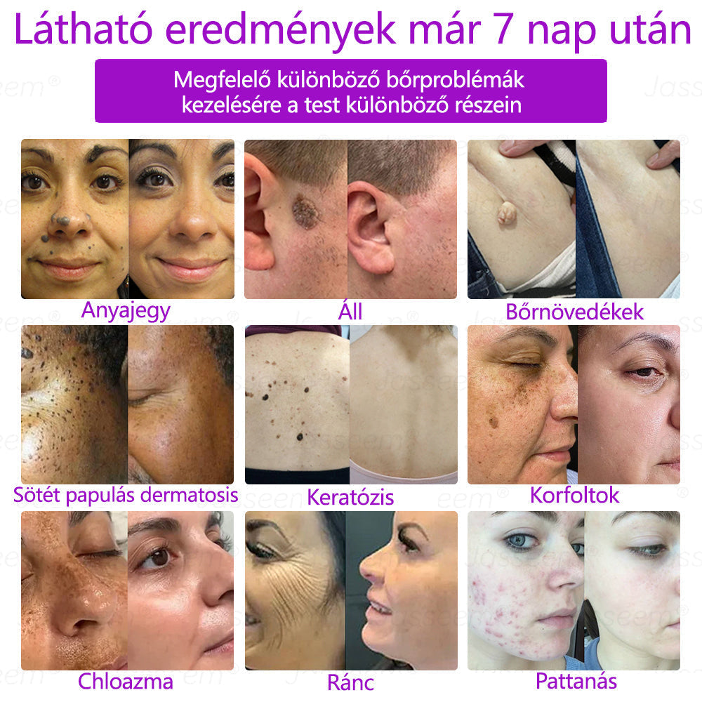 💎𝐉𝐚𝐬𝐬𝐞𝐞𝐦® Zaawansowany nieinwazyjny laser CO₂ do naprawy skóry 🎉 (Delikatnie usuwa brodawki, znamiona, plamy starcze i narośla skórne – bez bólu, bez zamieszania!)🚀