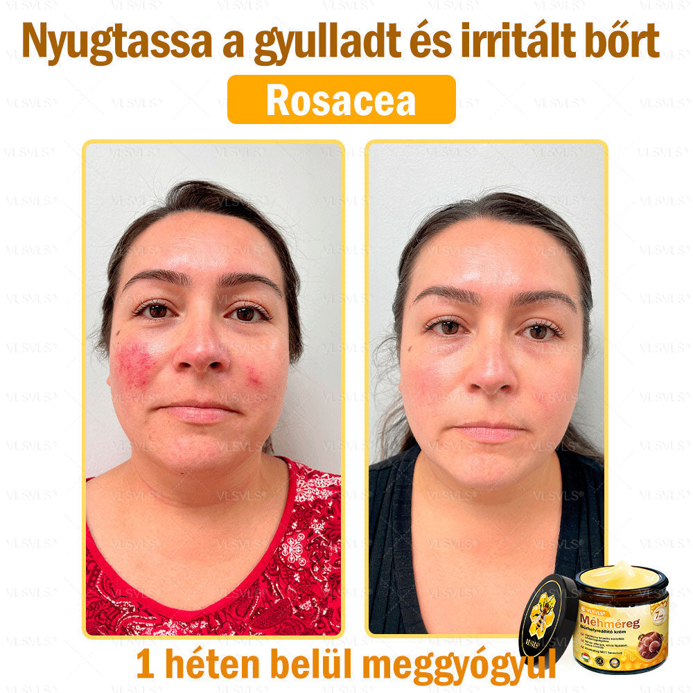 VLSVLS® Méhméreg Bőrhelyreállító Krém (👨⚕CE jóváhagyott)💎
