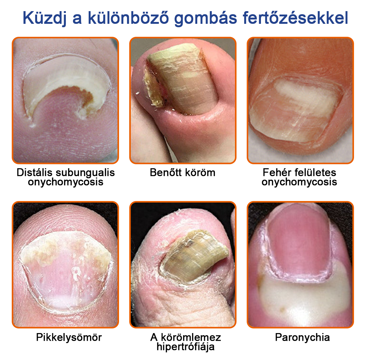 🐝Furzero™ Méhméreg Körömgomba Kezelőoldat: Teljes megoldás a körömgomba problémájára🌟