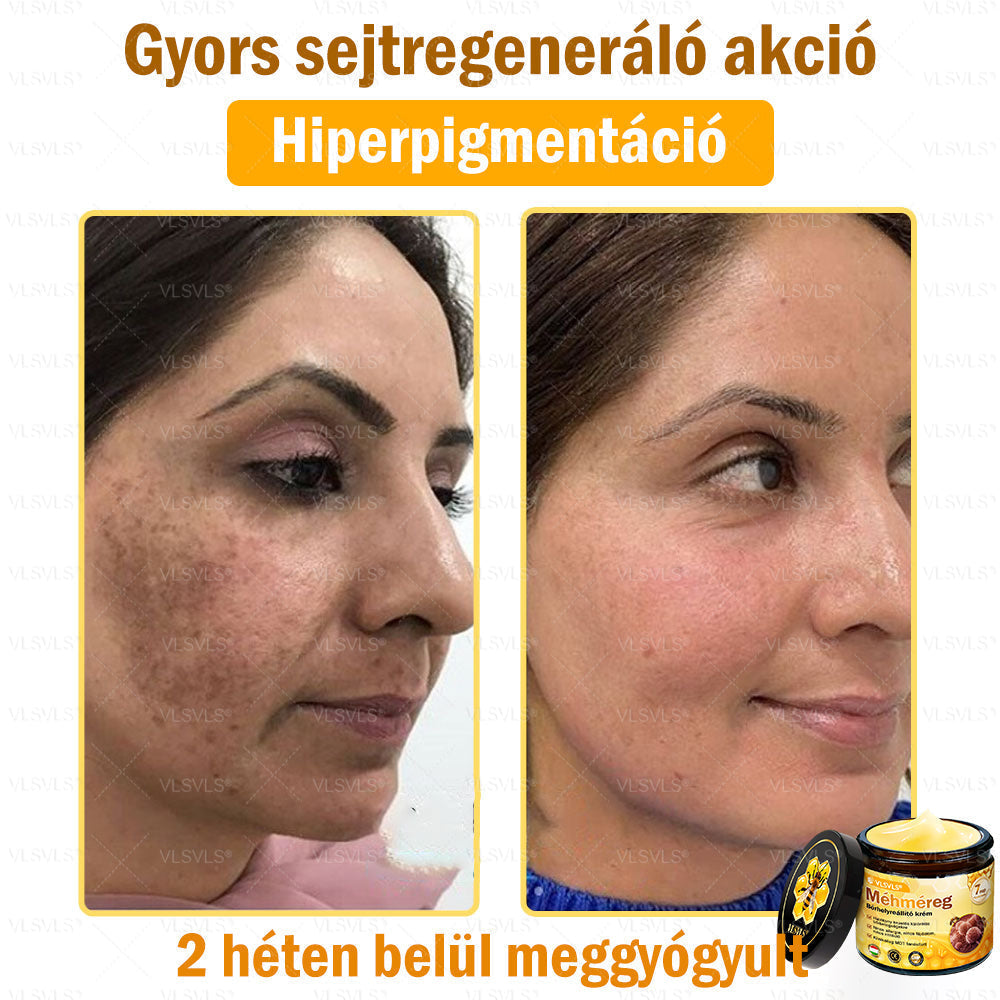 VLSVLS® Méhméreg Bőrhelyreállító Krém (👨⚕CE jóváhagyott)💎