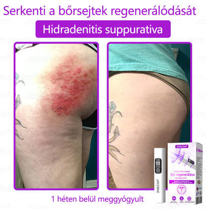 💎𝐉𝐚𝐬𝐬𝐞𝐞𝐦® Zaawansowany nieinwazyjny laser CO₂ do naprawy skóry 🎉 (Delikatnie usuwa brodawki, znamiona, plamy starcze i narośla skórne – bez bólu, bez zamieszania!)🚀