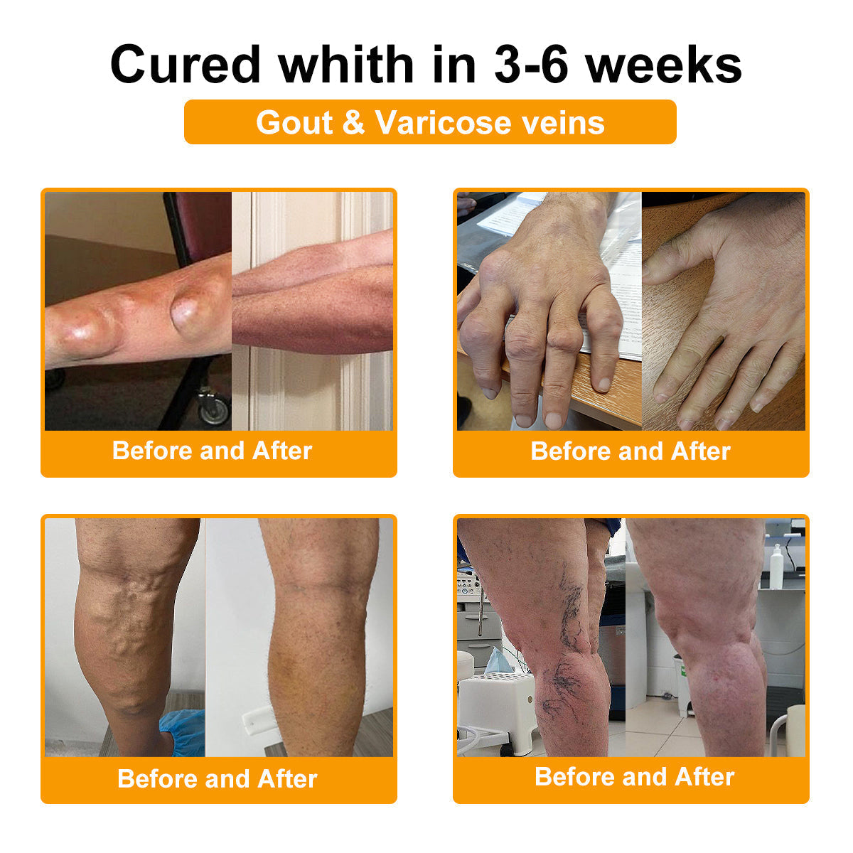 🌟TLOPA® Botulinum Toxin és Méhméreg Fájdalomcsillapító Csontgyógyító Krém🐝 🔥(Kifejezetten időseknek & ortopéd szakorvosok ajánlásával)🦴