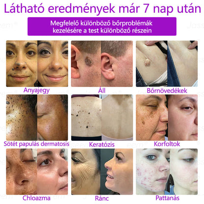 💎𝐉𝐚𝐬𝐬𝐞𝐞𝐦® Zaawansowany nieinwazyjny laser CO₂ do naprawy skóry 🎉 (Delikatnie usuwa brodawki, znamiona, plamy starcze i narośla skórne – bez bólu, bez zamieszania!)🚀