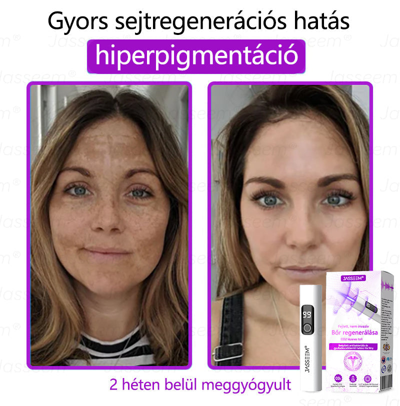 💎𝐉𝐚𝐬𝐬𝐞𝐞𝐦® Zaawansowany nieinwazyjny laser CO₂ do naprawy skóry 🎉 (Delikatnie usuwa brodawki, znamiona, plamy starcze i narośla skórne – bez bólu, bez zamieszania!)🚀
