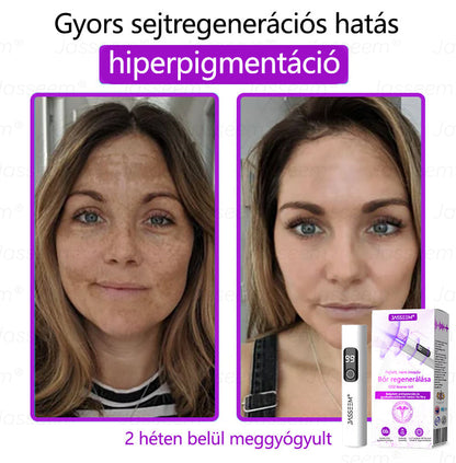 💎𝐉𝐚𝐬𝐬𝐞𝐞𝐦® Zaawansowany nieinwazyjny laser CO₂ do naprawy skóry 🎉 (Delikatnie usuwa brodawki, znamiona, plamy starcze i narośla skórne – bez bólu, bez zamieszania!)🚀