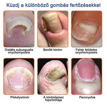 🐝Furzero™ Méhméreg Körömgomba Kezelőoldat: Teljes megoldás a körömgomba problémájára🌟