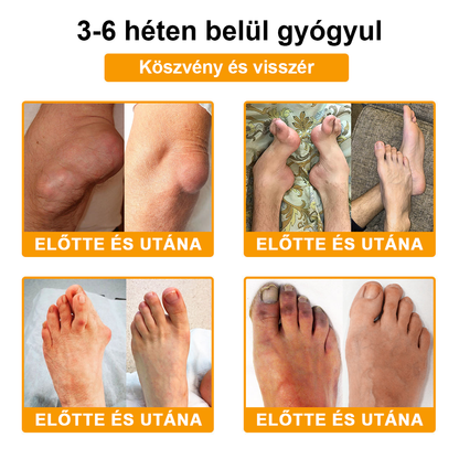 🌟TLOPA® Botulinum Toxin és Méhméreg Fájdalomcsillapító Csontgyógyító Krém🐝 🔥(Kifejezetten időseknek & ortopéd szakorvosok ajánlásával)🦴