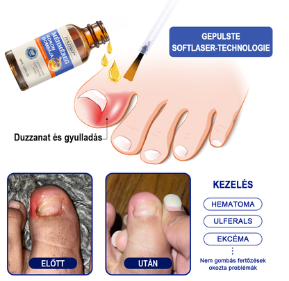 🐝Furzero™ Méhméreg Körömgomba Kezelőoldat: Teljes megoldás a körömgomba problémájára🌟
